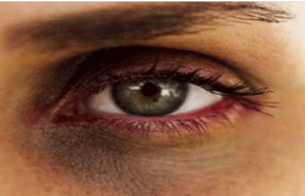 روش خانگی نابودی سیاهی دور چشم / این ویتامین‌ها را کم دارید!